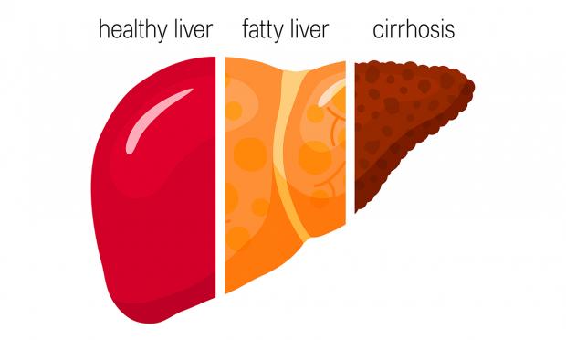 Cirrhosis