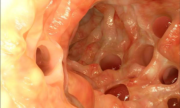 Diverticulitis