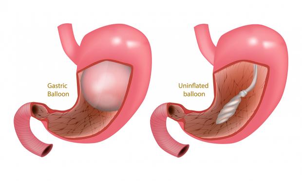 intragastric balloon