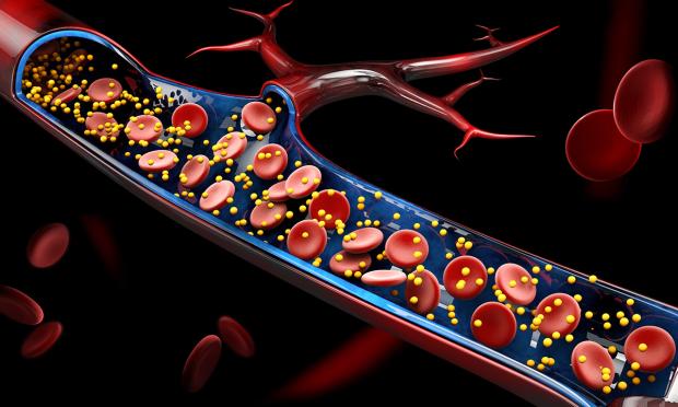 Integrating Coronary Artery Calcium Scoring Into Cardiovascular Prevention in Australia