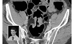 CT colonography and Tom Sutherland