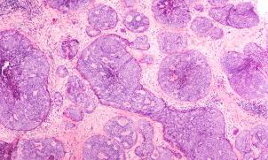 cancer pathology